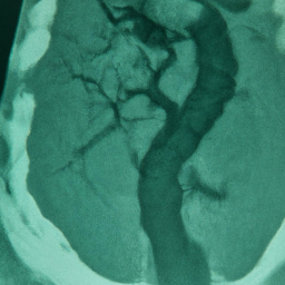 Indocyanine Green Angiography